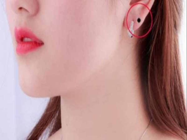 Nốt ruồi ở dái tai