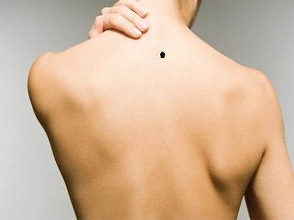 Tổng quan ý nghĩa chung của nốt ruồi sau lưng