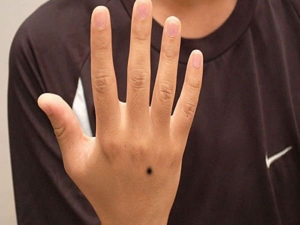 Nốt ruồi trên mu bàn tay phải