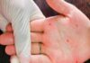 Xem nốt ruồi son trong lòng bàn tay luận giàu sang phú quý