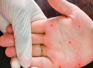 Xem nốt ruồi son trong lòng bàn tay luận giàu sang phú quý