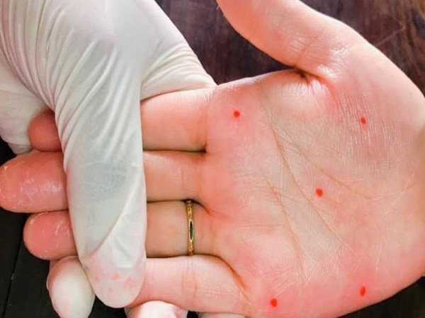 Ý nghĩa chung của nốt ruồi son trong lòng bàn tay