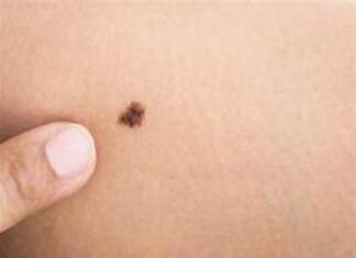 Nam nữ có nốt ruồi ở bẹn dự báo điều gì về vận mệnh? nốt ruồi ở bẹn