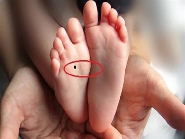 Luận ý nghĩa mụn ruồi dưới lòng bàn chân theo màu sắc