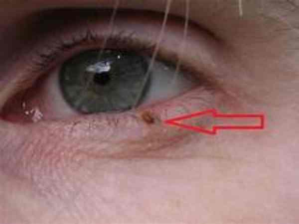 Ý nghĩa chung của nốt ruồi dưới mi mắt theo nhân tướng học Ý nghĩa chung của nốt ruồi dưới mi mắt theo nhân tướng học