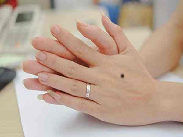 Nốt ruồi trên mu bàn tay phải nữ giới Nốt ruồi trên mu bàn tay phải nữ giới