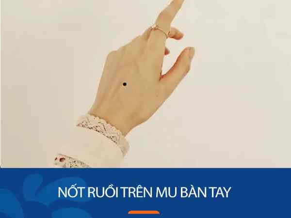 Nốt ruồi trên mu bàn tay Nốt ruồi trên mu bàn tay