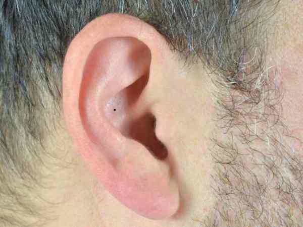 Nốt ruồi trong tai trái nam Nốt ruồi trong tai trái nam