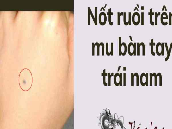 Nốt ruồi trên mu bàn tay trái nam giới nốt ruồi mu bàn tay